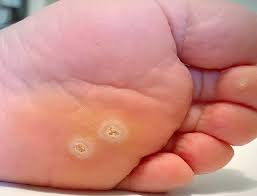 Warts, Verruca, Calluses